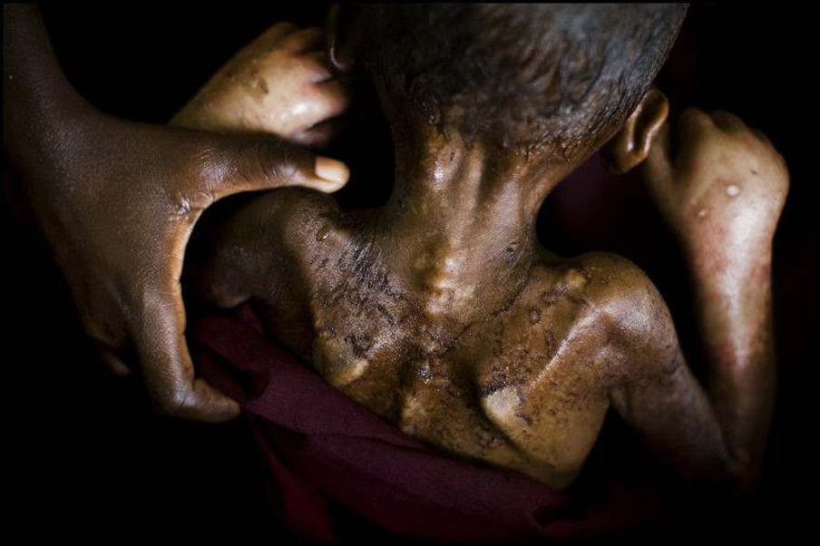 Een ondervoed kind in Somalië in 2011. Foto: Dominic Nahr / Magnum Photos / Hollandse Hoogte