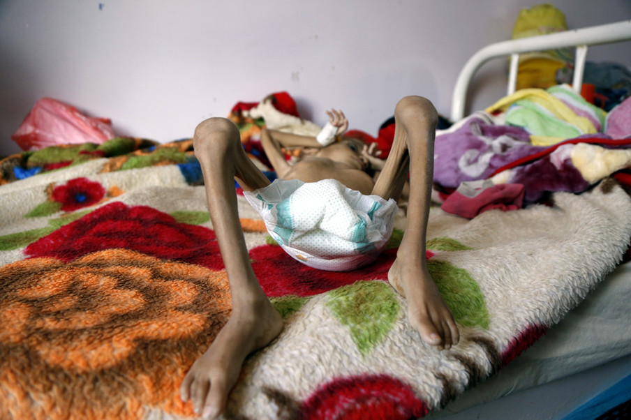 Een ondervoed kind in het Sabeen-ziekenhuis in Sana’a, Jemen, 6 oktober 2018. Foto: Mohammed Hamoud / Getty Images
