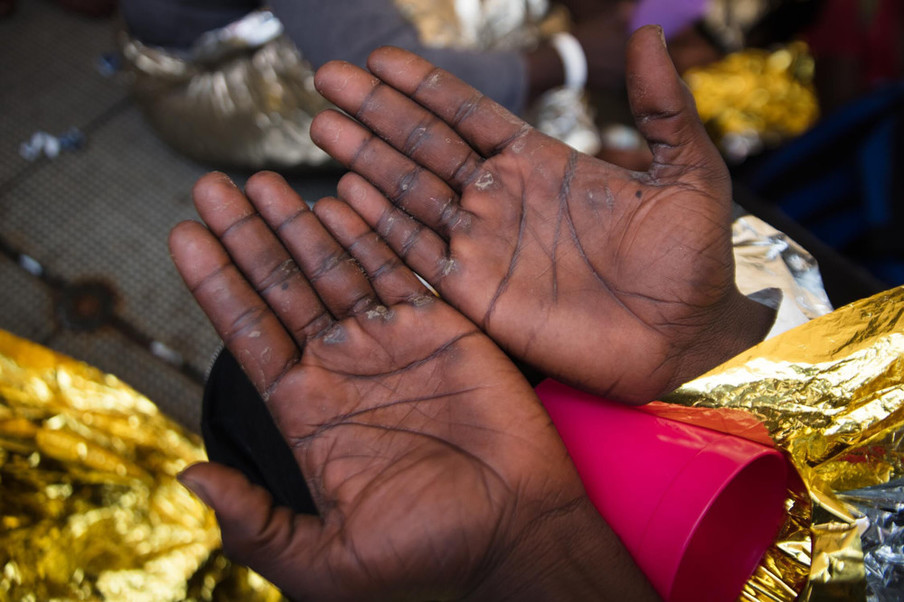 Een van de migranten toont zijn toegetakelde handen. Hij moest werken als slaaf in Libië, 5 juni 2018. Foto: Erik Marquardt