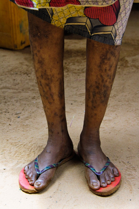 Fatima toont een onbekende huidaandoening op haar benen. Foto: Lucas Destrijcker